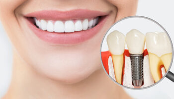 Exploring the Safety and Efficacy of Zirconia Dental Implants